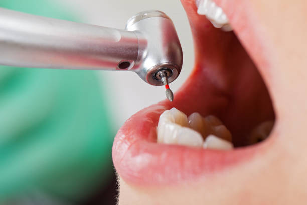 Best Emergency Tooth Extraction in Ketchum, ID